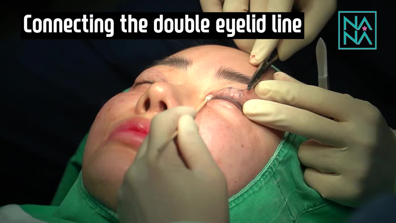 [LIVE] Non-Incision Double Eyelid Revision Surgery Korean Plastic Surgery