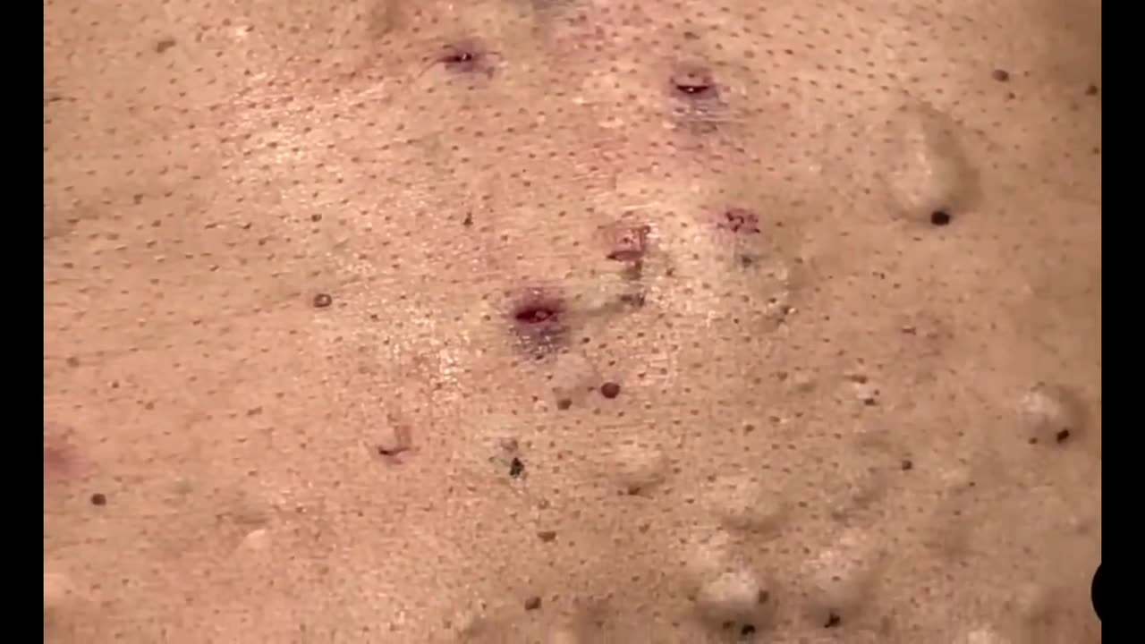 Blackhead on the back