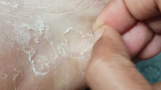 Skin peeling video from feet