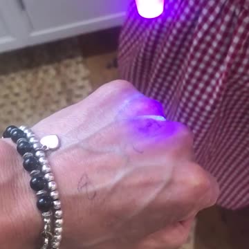 Ai PUNTURATI con il siero appare questo segno sul punto della iniezione.