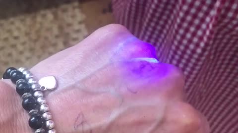 Ai PUNTURATI con il siero appare questo segno sul punto della iniezione.