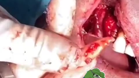 🖥 Infected gum surgery 🦷