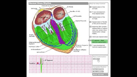 Dr Stanley's ECGcourse.com | Normal Sinus Rhythm Tutorial