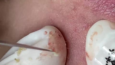 Satisfying acne squeezing video | Relaxing for you every day | 001