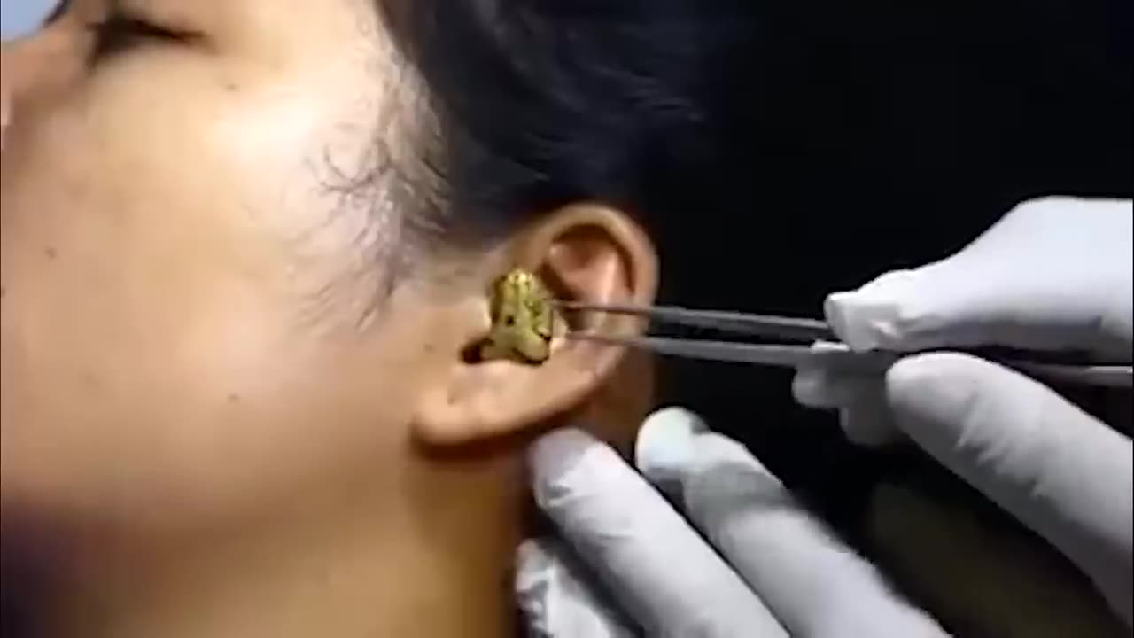 Surgeon Removes Snake from a Womans Ear