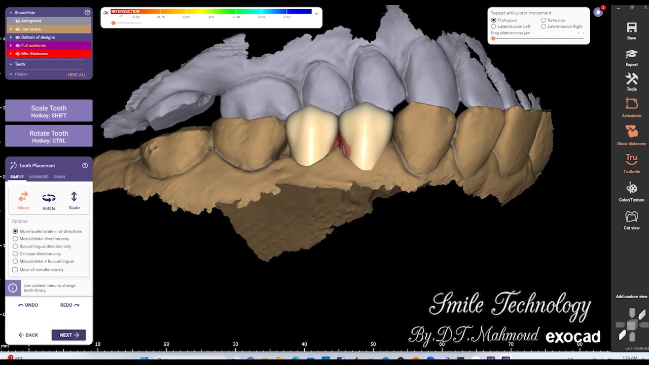 #design #naildesign #dental #dentaldesign #exocadexpert