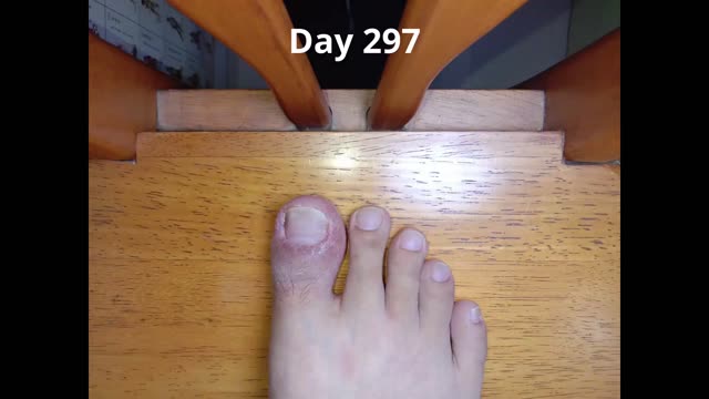 I have a toenail injury and its healing day by day(timelapse).