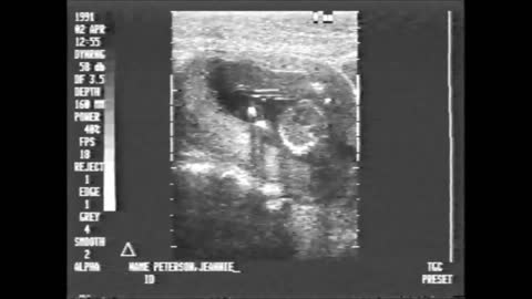 1991 Nolan Sonograms