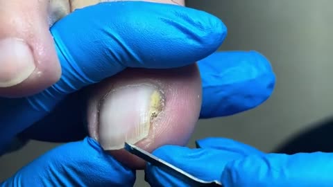 Deep ingrown removal