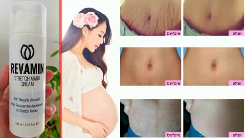Revamin Stretch Mark Review Say goodbye to stretch marks,Order now a limited quantity