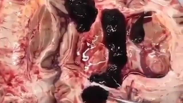 Intracerebral hemorrhage discovered during brain autopsy after a vaccine.