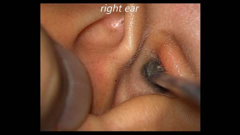 Earwax