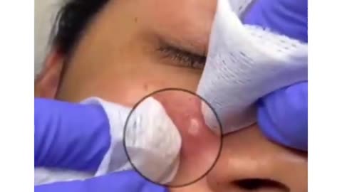 Best of Blackheads Removal