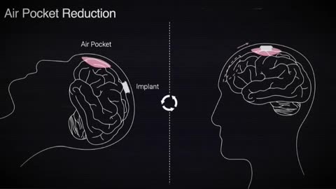 Neuralink's 9.5 BPS: Overcoming Brain Implant Challenges