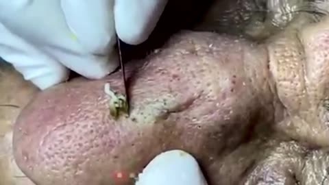 Super satisfying blackhead extraction