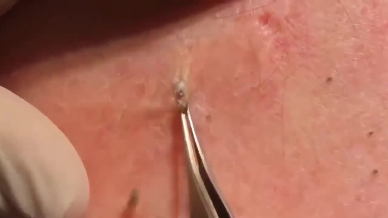 VERY BIG LARGE BLACKHEADS REMOVAL