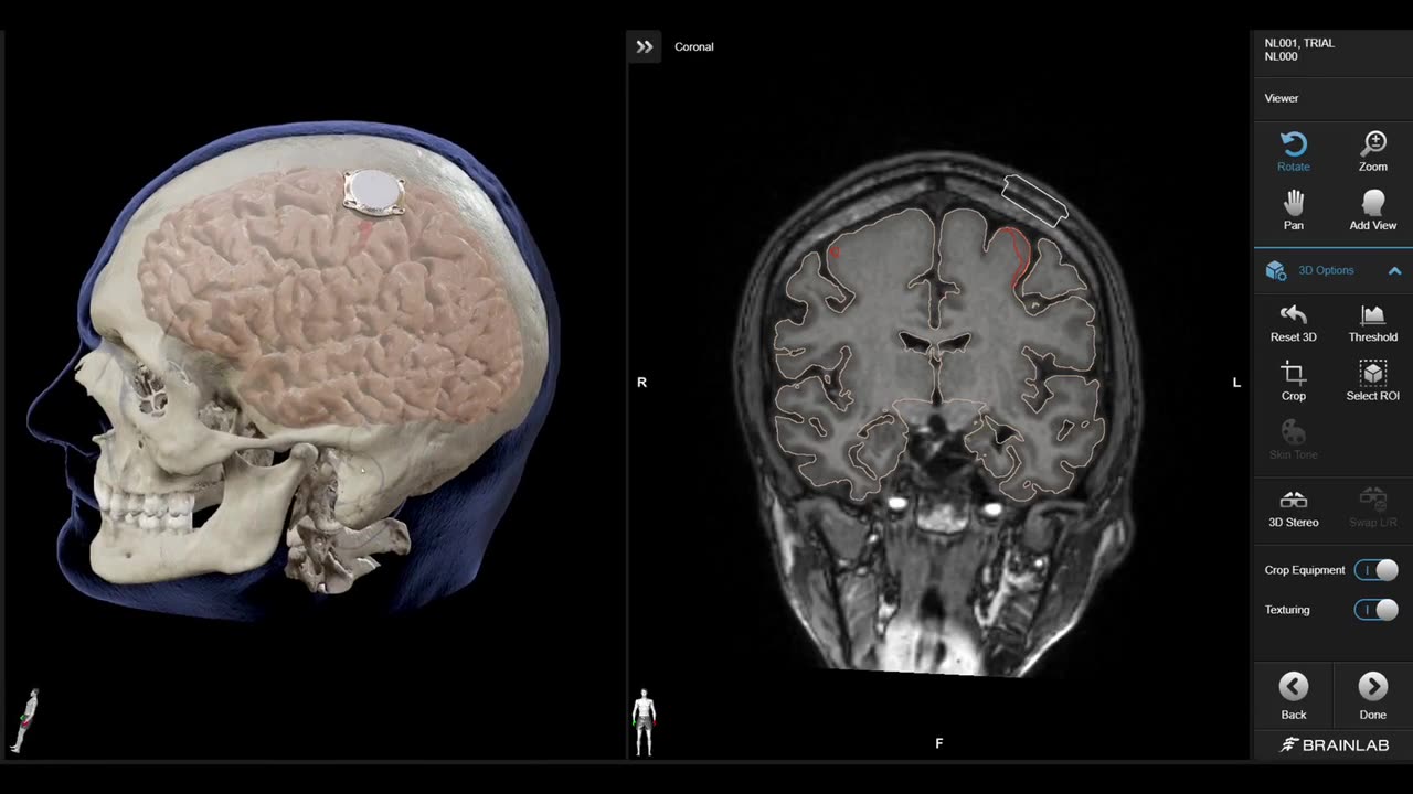 Neuralink brain scans each recipient for optimum placement of the brain chip...