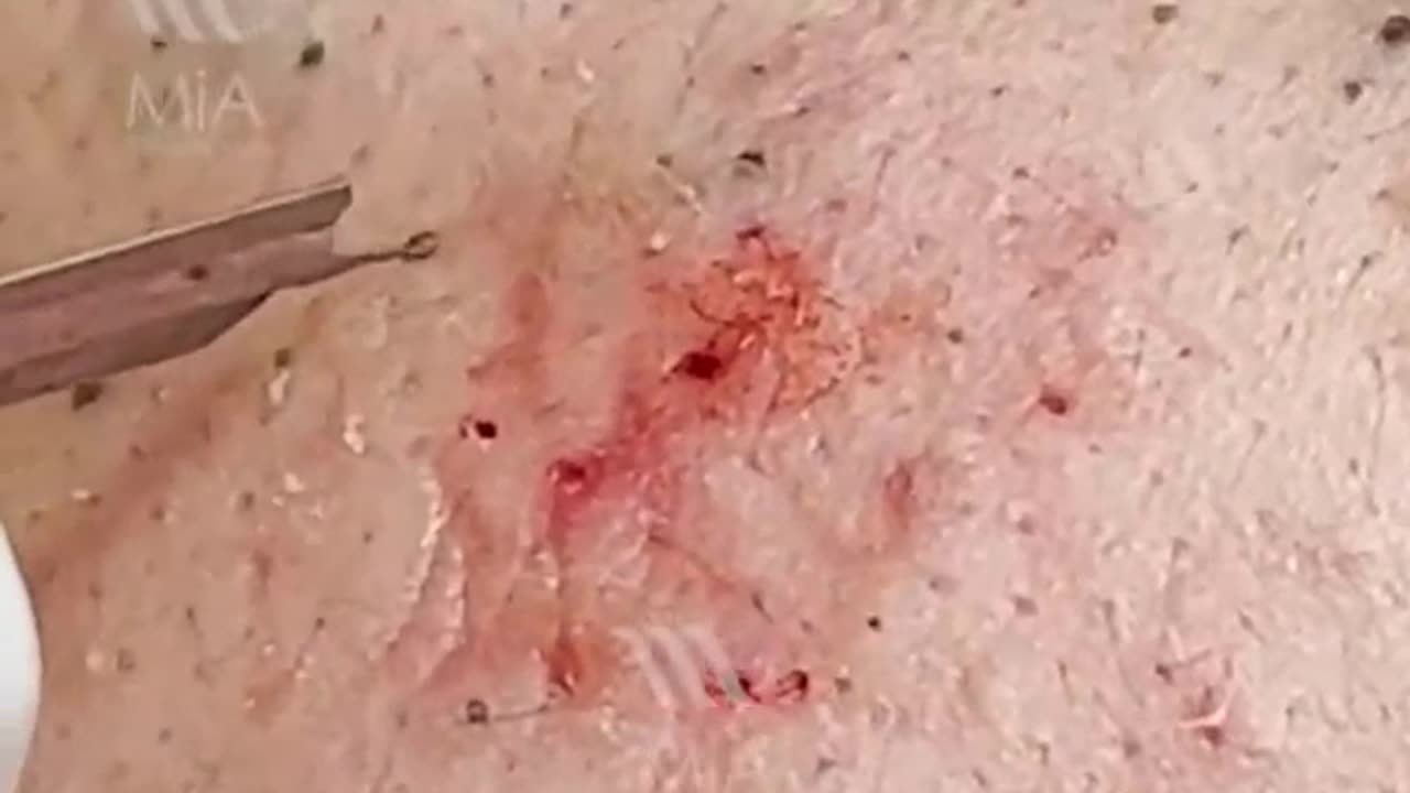 pimple popping