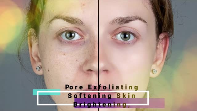 The Areton Salicylic Acid Soap with Kojic Acid,Sulphur,Aloe Vera for Skin Care