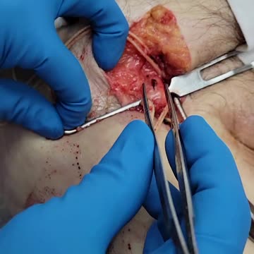 Embalmer Richard Hirschman Releases Footage of Unbelievable Blood Clots