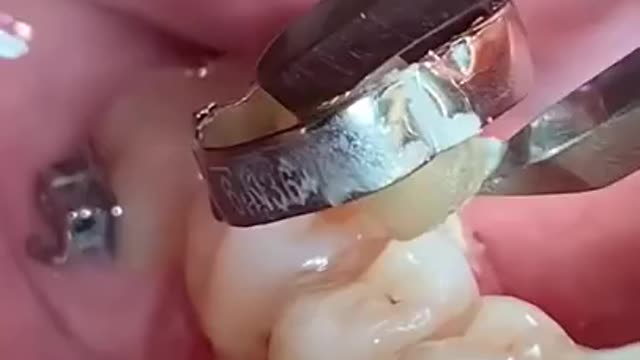 Cómo quitar banda metálica de los dientes.