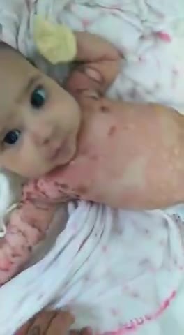 HEARTWRENCHING!! BABY HAS SEVERE SKIN IRRITATION FROM INJECTED MOTHER (RUMBLE SUPPRESSED VIDEO)