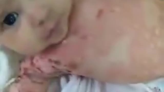 HEARTWRENCHING!! BABY HAS SEVERE SKIN IRRITATION FROM INJECTED MOTHER (RUMBLE SUPPRESSED VIDEO)