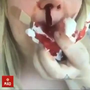 Nosebleeds - Nasenbluten