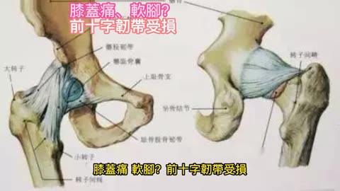 膝蓋痛、軟腳？ 前十字韌帶受損