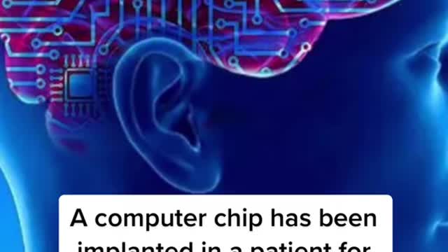 A computer chip has been implanted in a patient for the first time