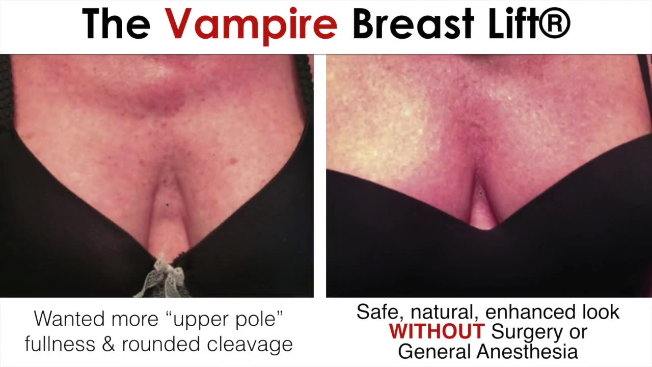 Vampire Breast Lift at Las Vegas Aesthetics