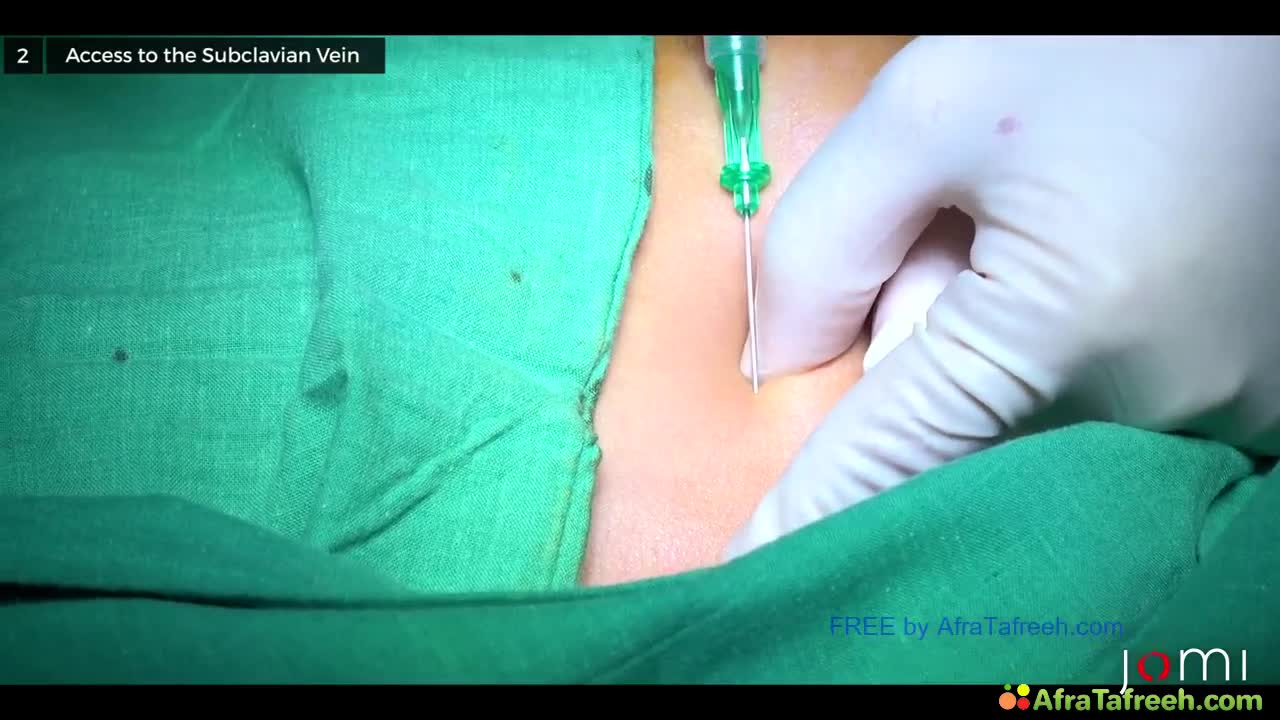 5. Blind Technique for Subclavian Central Line Placement atf