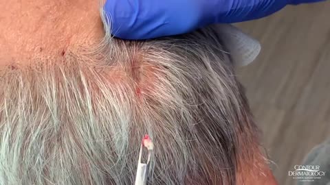 Blackheads Extraction From Behind the Head (Connect The Dots)