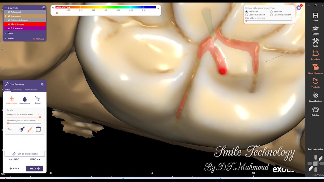 #design #naildesign #dental #dentaldesign #exocadexpert