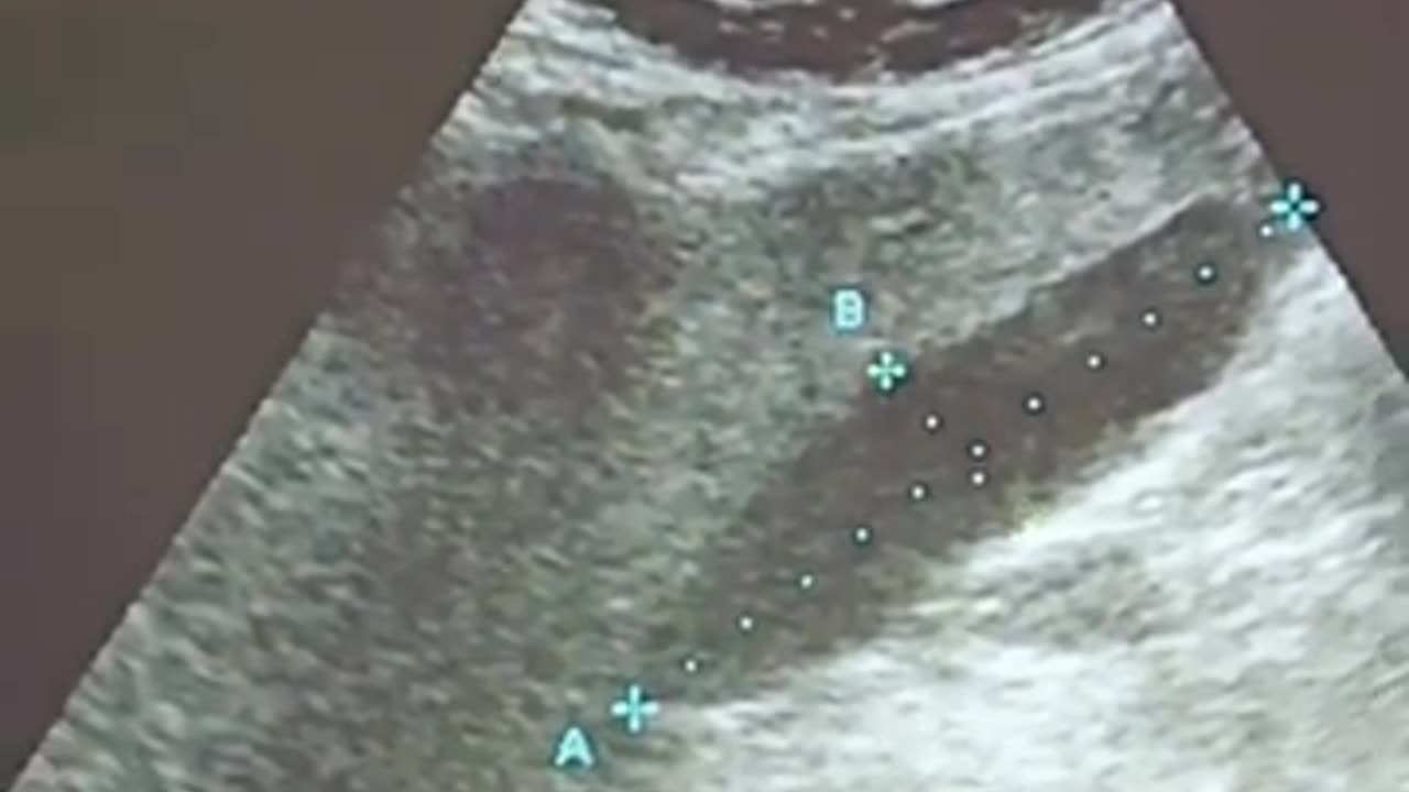 #multiple gallstones with mucosal fold and hydronephrotic R kidney