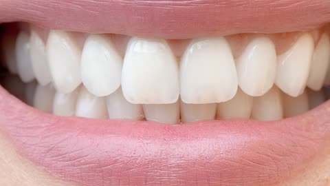 About Natural Teeth Whitening