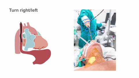 02. How to use the TEE probe—manipulating the probe position