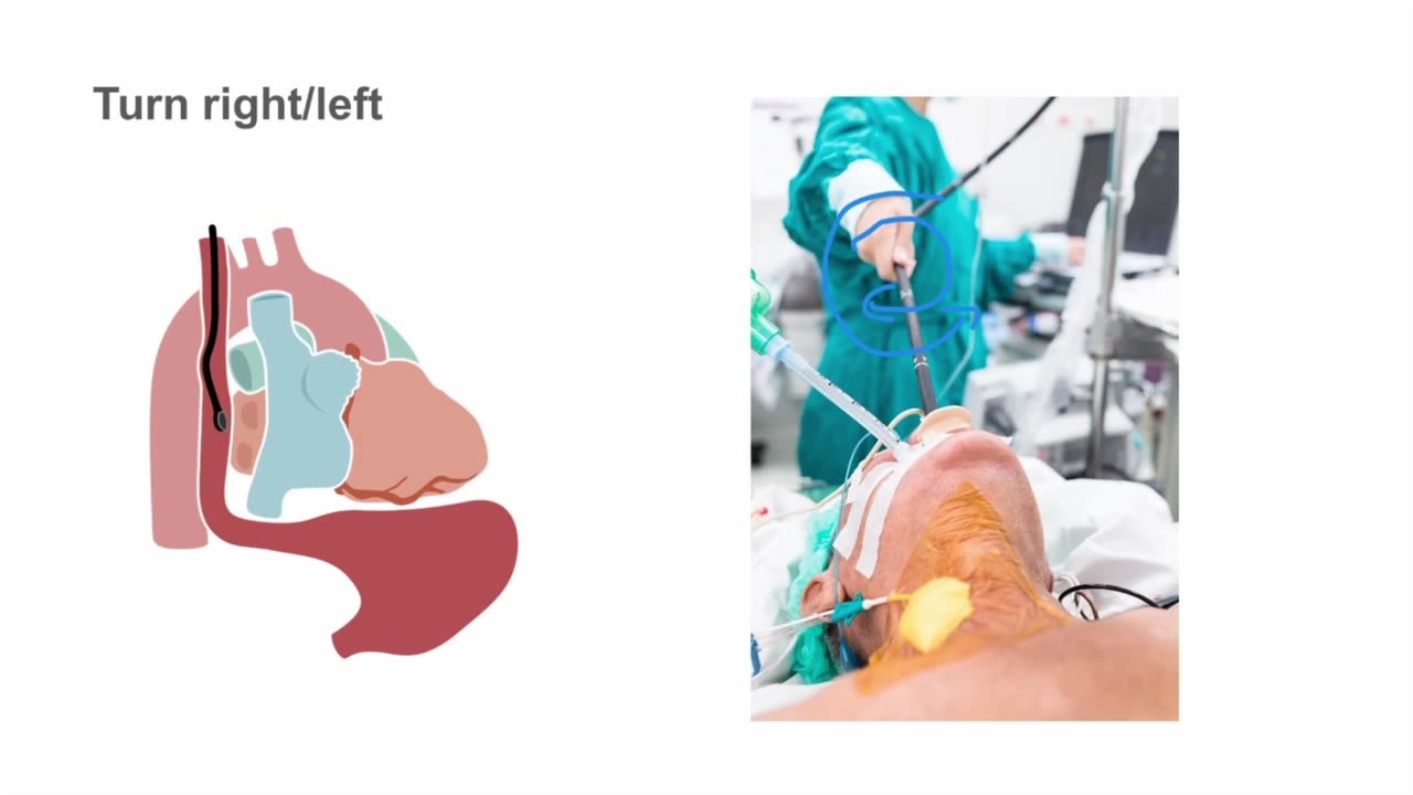 02. How to use the TEE probe—manipulating the probe position