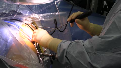 Labral Reconstruction