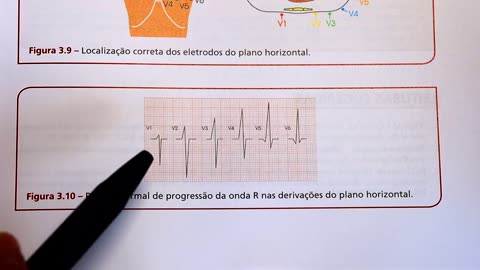 Dicas de ECG - qual é a progressão normal da onda R