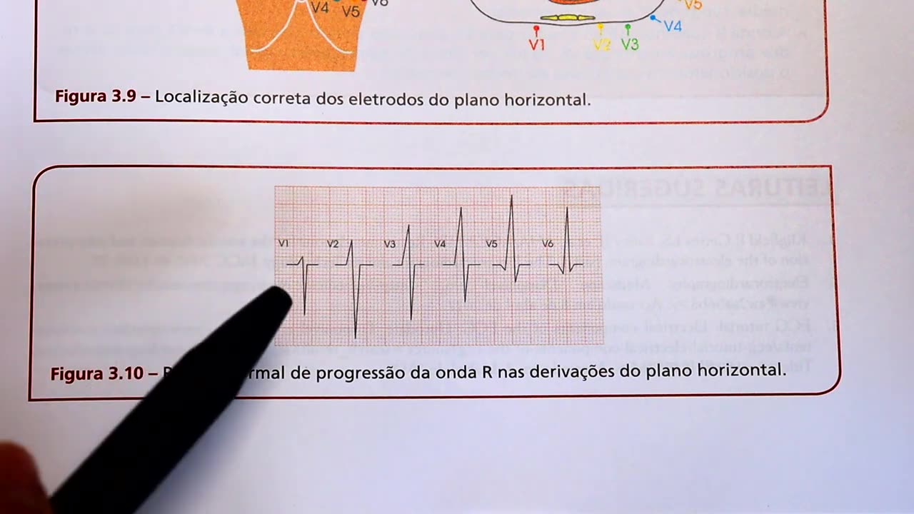 Dicas de ECG - qual é a progressão normal da onda R