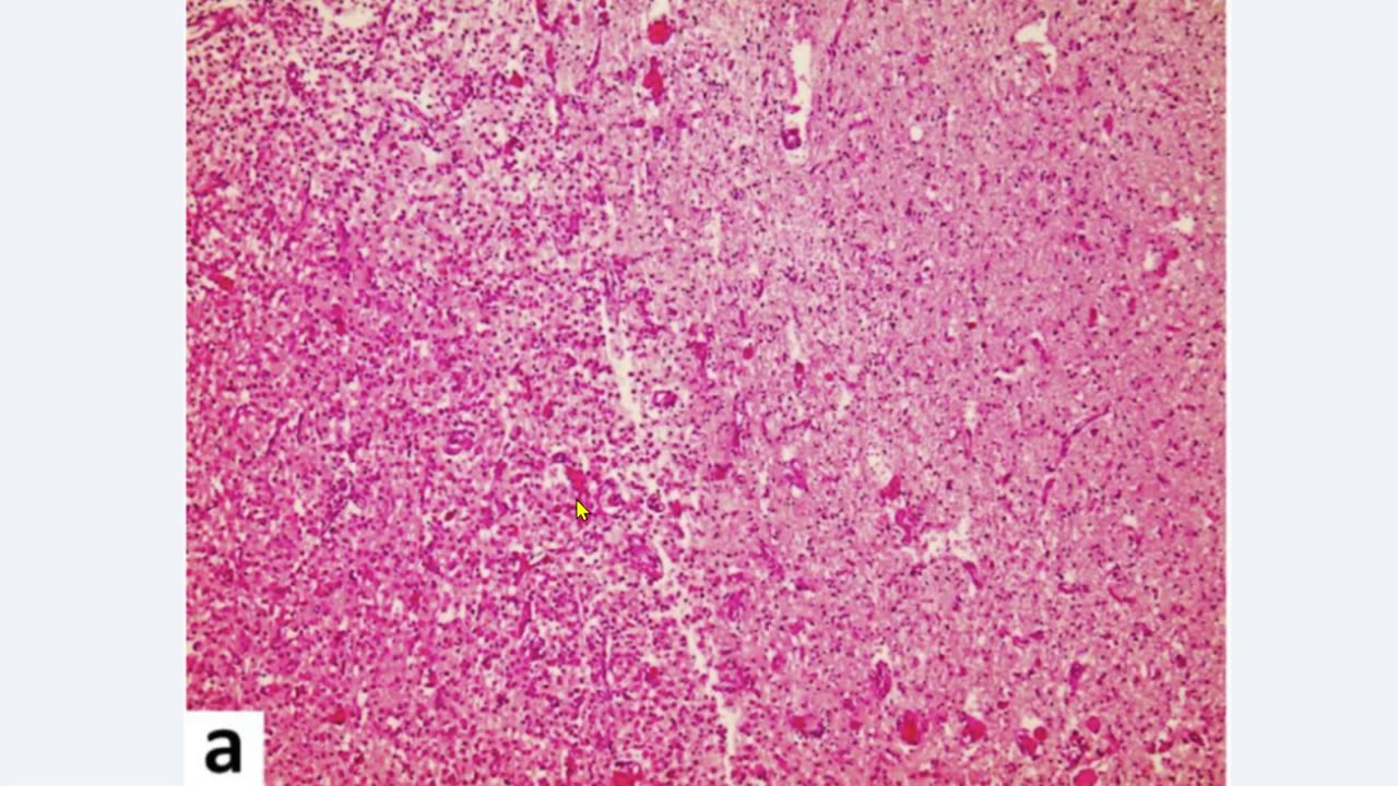 Dr. John Campbell: Brain and heart injury definitively caused by vaxx, NOT natural infection