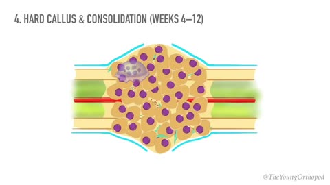 Bone Healing: Cracking the Code