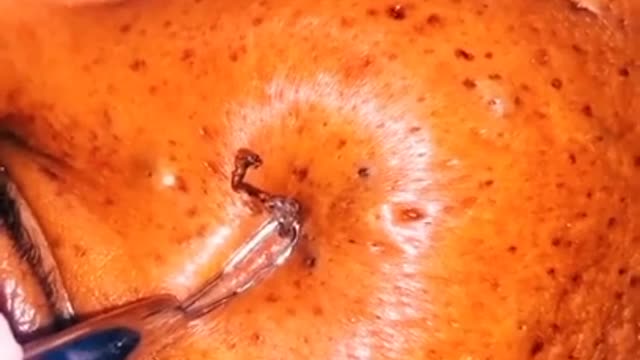 How to remove blackheads from nose, pop pimples, acne treatment #82 #shorts