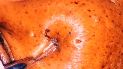 How to remove blackheads from nose, pop pimples, acne treatment #82 #shorts
