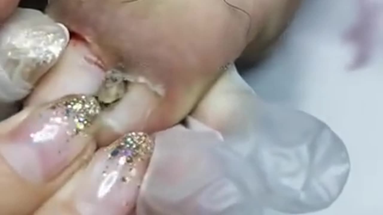 Removal Old Toenail & Long Big Ingrown Toenail