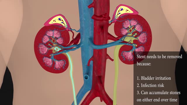 3D animation of ureteroscopy