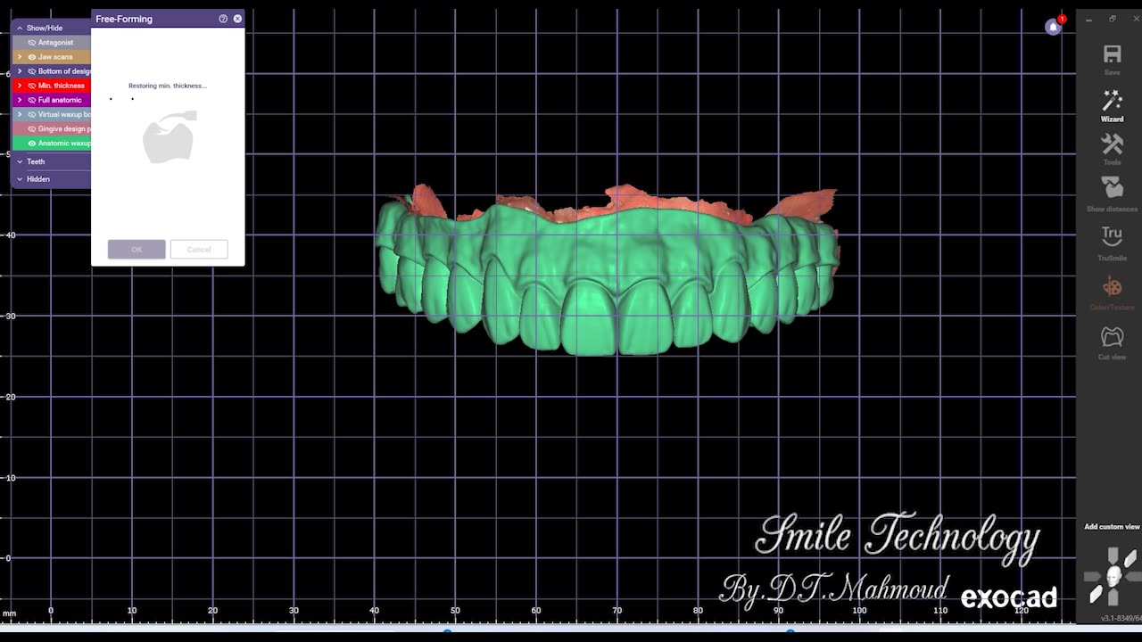 All on X #dailywork #design #naildesign #dental #dentaldesign #exocadexpert #allonx