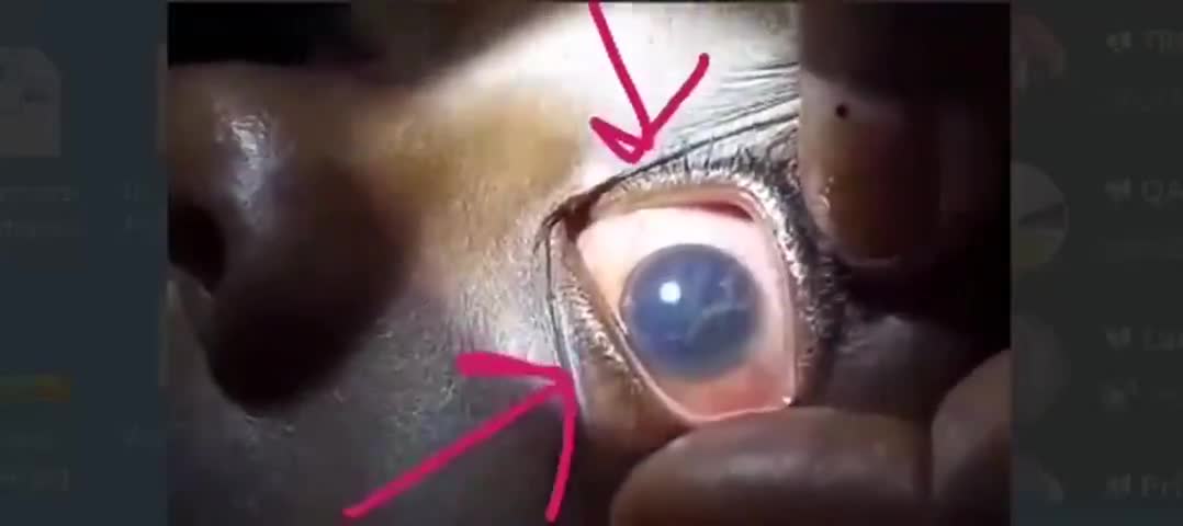 FREAK OUT ALERT - Dr. records Hydra Vulgaris swimming in the eye of an 11yr old vaxxed patient