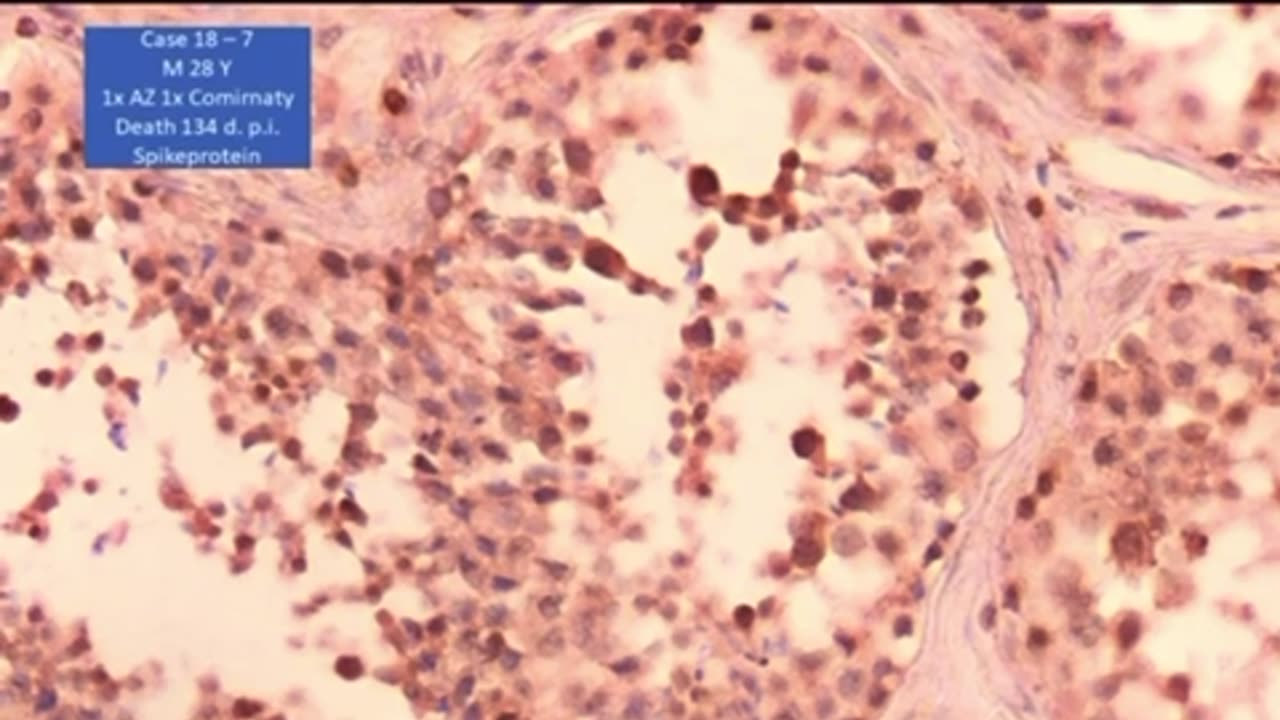Spike protein is in the testes, almost no spermatocytes in here.